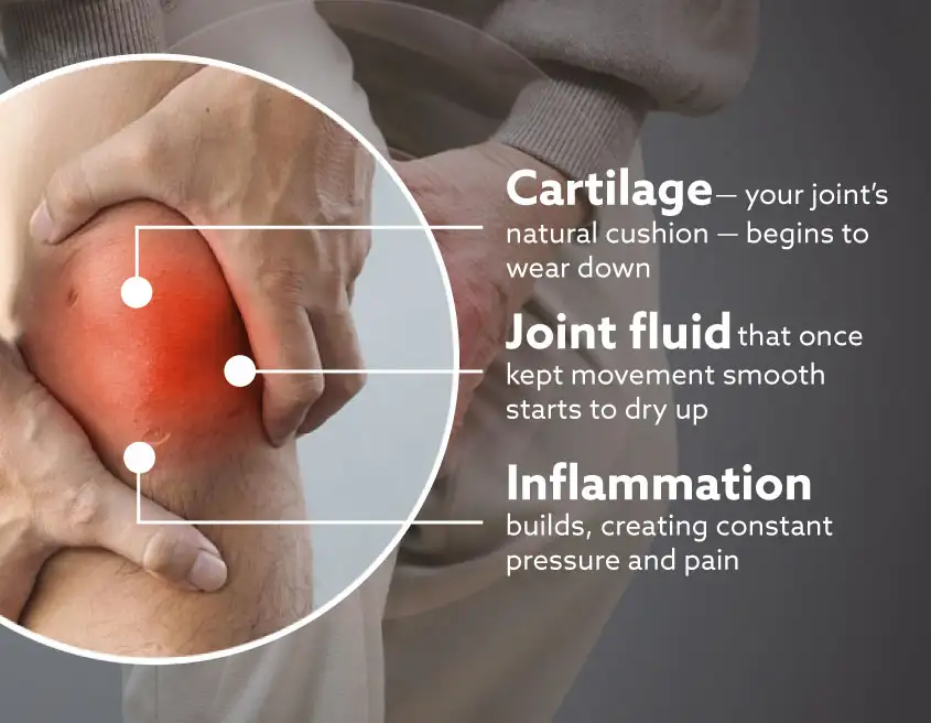 Joint cartilage and synovial fluid diagram